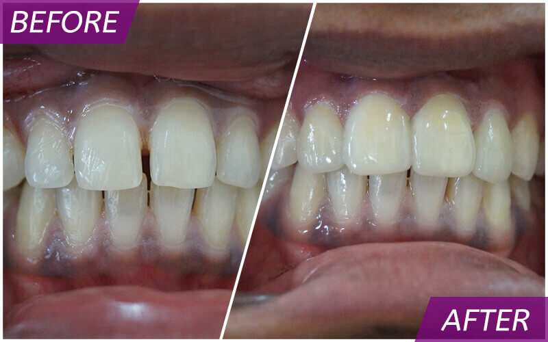 Teeth before and after image